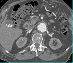 Renal Artery Stenosis - CTisus CT Scan