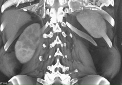 Transitional Cell Carcinoma - CTisus CT Scan