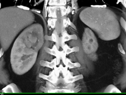 Transitional Cell Carcinoma - CTisus CT Scan