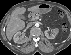 Transitional Cell Carcinoma - CTisus CT Scan