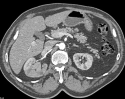 Transitional Cell Carcinoma - CTisus CT Scan