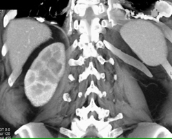 Transitional Cell Carcinoma - CTisus CT Scan