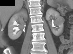 Transitional Cell Carcinoma - CTisus CT Scan