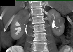 Transitional Cell Carcinoma - CTisus CT Scan