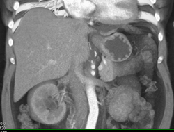 Transitional Cell Carcinoma - CTisus CT Scan