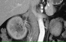 Transitional Cell Carcinoma - CTisus CT Scan