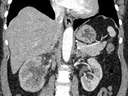 Transitional Cell Carcinoma - CTisus CT Scan