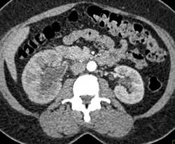 Transitional Cell Carcinoma - CTisus CT Scan