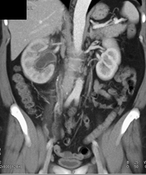 Transitional Cell Cancer (TCC) of the Ureter - CTisus CT Scan