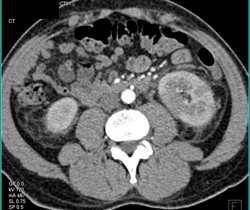 Acute Pyelonephritis - CTisus CT Scan