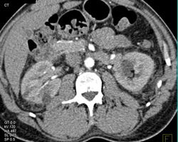 Acute Pyelonephritis - CTisus CT Scan