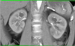 Acute Pyelonephritis - CTisus CT Scan