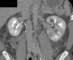 Acute Pyelonephritis - CTisus CT Scan