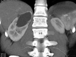 Duplicated Upper Collecting System With Ectopic Ureter Insertion - CTisus CT Scan