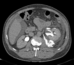 Contrast Extravasation - CTisus CT Scan