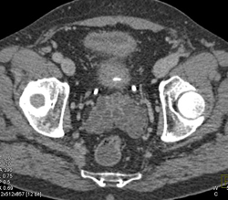 Cystic Changes Prostate - CTisus CT Scan