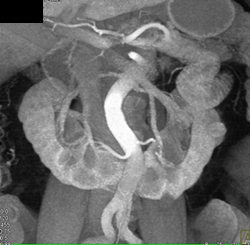 Horseshoe Kidney - CTisus CT Scan