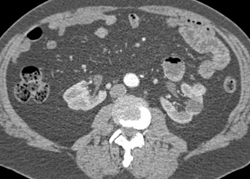 Horseshoe Kidney - CTisus CT Scan