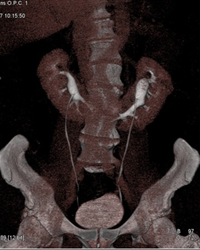 Horseshoe Kidney - CTisus CT Scan