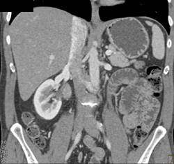 Transitional Cell Carcinoma - CTisus CT Scan