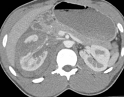 Renal Laceration - CTisus CT Scan