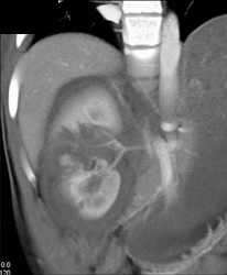 Renal Laceration - CTisus CT Scan