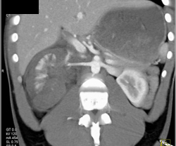 Renal Laceration - CTisus CT Scan