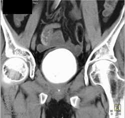 Ct Cytogramn W/o Leak - CTisus CT Scan