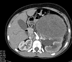 Renal Cell Carcinoma in Different Phases of Acquisition - CTisus CT Scan