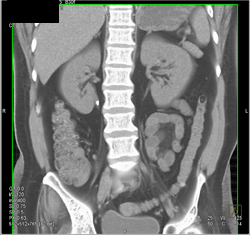 Stone in Proximal Right Ureter - CTisus CT Scan