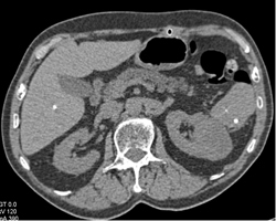 Renal Cell Carcinoma in Multiple Phases - CTisus CT Scan