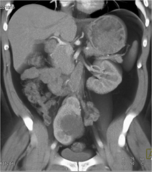 Pelvic Kidney - CTisus CT Scan