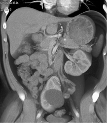 Pelvic Kidney - CTisus CT Scan