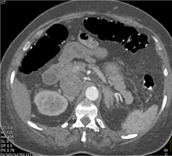Renal Cell Carcinoma Extends Into Renal Vein, IVC, and Right Atrium - CTisus CT Scan