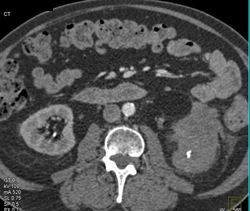 Poor Function to Left Kidney - CTisus CT Scan