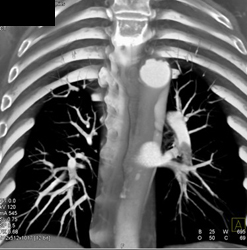 Transitional Cell Cancer (TCC) Presents as Pulmonary Embolism (PE) - CTisus CT Scan