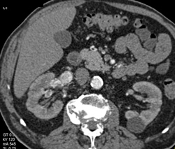 Transitional Cell Cancer (TCC) Invades Inferior Vena Cava (IVC) - CTisus CT Scan