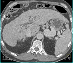 Huge Renal Vein Due to Splenorenal Shunting - CTisus CT Scan