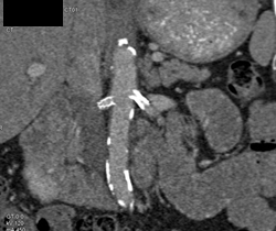 Patent Stents in Renal Artery - CTisus CT Scan