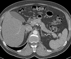 Renal Calculus - CTisus CT Scan