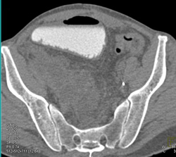 Neobladder With CT Urogram - CTisus CT Scan