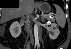 Renal Artery Aneurysm - CTisus CT Scan