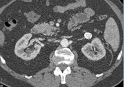 Renal Artery Aneurysm - CTisus CT Scan