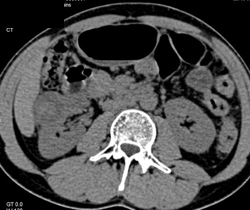 Renal Cell Carcinoma - CTisus CT Scan