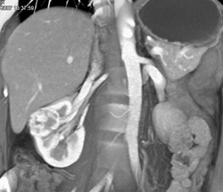 Renal Cell Carcinoma - CTisus CT Scan