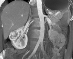 Renal Cell Carcinoma - CTisus CT Scan