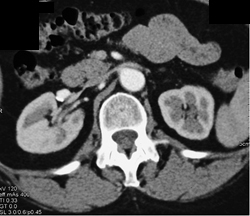 Renal Artery Aneurysm on Right - CTisus CT Scan