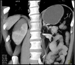 Renal Infarct- Segmental - CTisus CT Scan