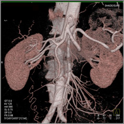 Multiple Renal Arteries in A Renal Donor - CTisus CT Scan