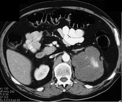 Renal Lymphoma - CTisus CT Scan